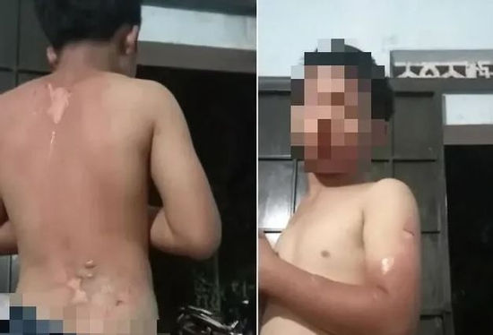 Xót xa bé trai ở Đắk Lắk với nhiều vết phồng rộp trên lưng nghi bị mẹ tạt nước sôi: Công an thông tin kết quả xác minh ban đầu