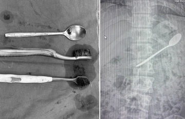 Tìm thấy nhiều bàn chải đánh răng, thìa inox trong dạ dày nam thanh niên Hà Nội