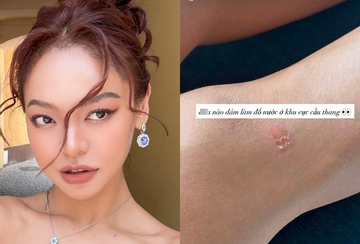 Mai Ngô gặp chấn thương trước phần thi Top Model tại Miss Supranational 2026