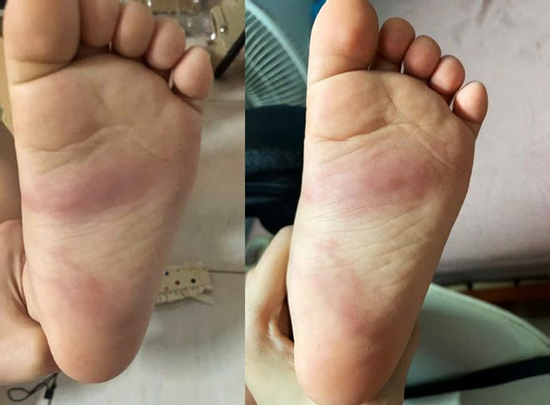 Hưng Yên: Xác minh phản ánh trẻ 3 tuổi bị bầm tím chân sau khi ở trường mầm non về