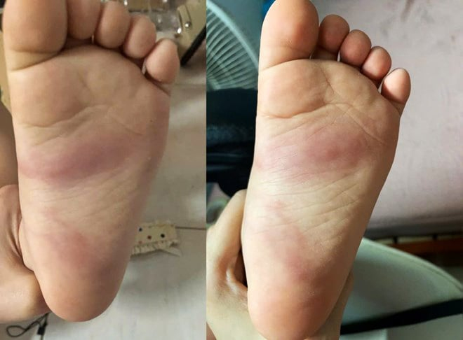 Hưng Yên: Xác minh phản ánh trẻ 3 tuổi bị bầm tím chân sau khi ở trường mầm non về