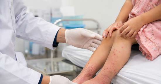 Bé gái 5 tháng tuổi nhập viện vì bong vảy toàn thân, bác sĩ phát hiện bệnh hiếm