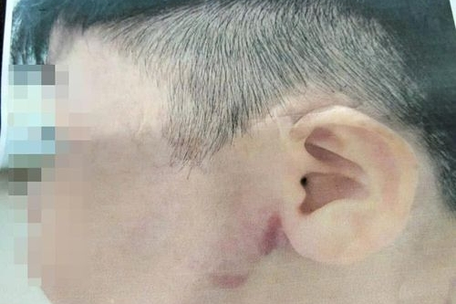 Điều tra vụ bé trai 9 tuổi nghi bị cha ruột bạo hành ở TPHCM