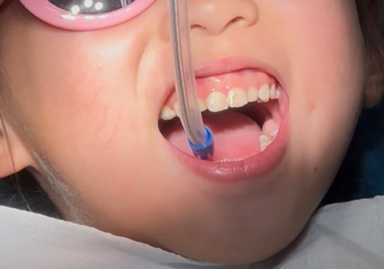 Lý do tiến sĩ dược làm việc ở Mỹ đưa con về Việt Nam chữa răng sâu