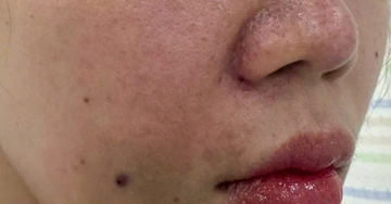 Cô gái bị tắc mạch, hoại tử sau khi tiêm filler làm đầy rãnh cười ở spa