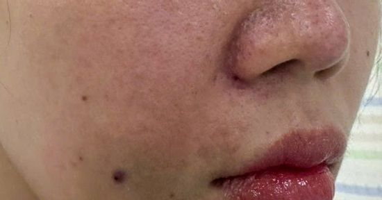 Cô gái bị tắc mạch, hoại tử sau khi tiêm filler làm đầy rãnh cười ở spa
