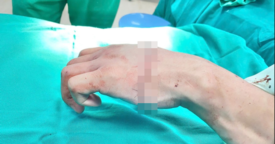 Bàn tay gần đứt lìa, nam thanh niên 21 tuổi cử động được các ngón sau vi phẫu